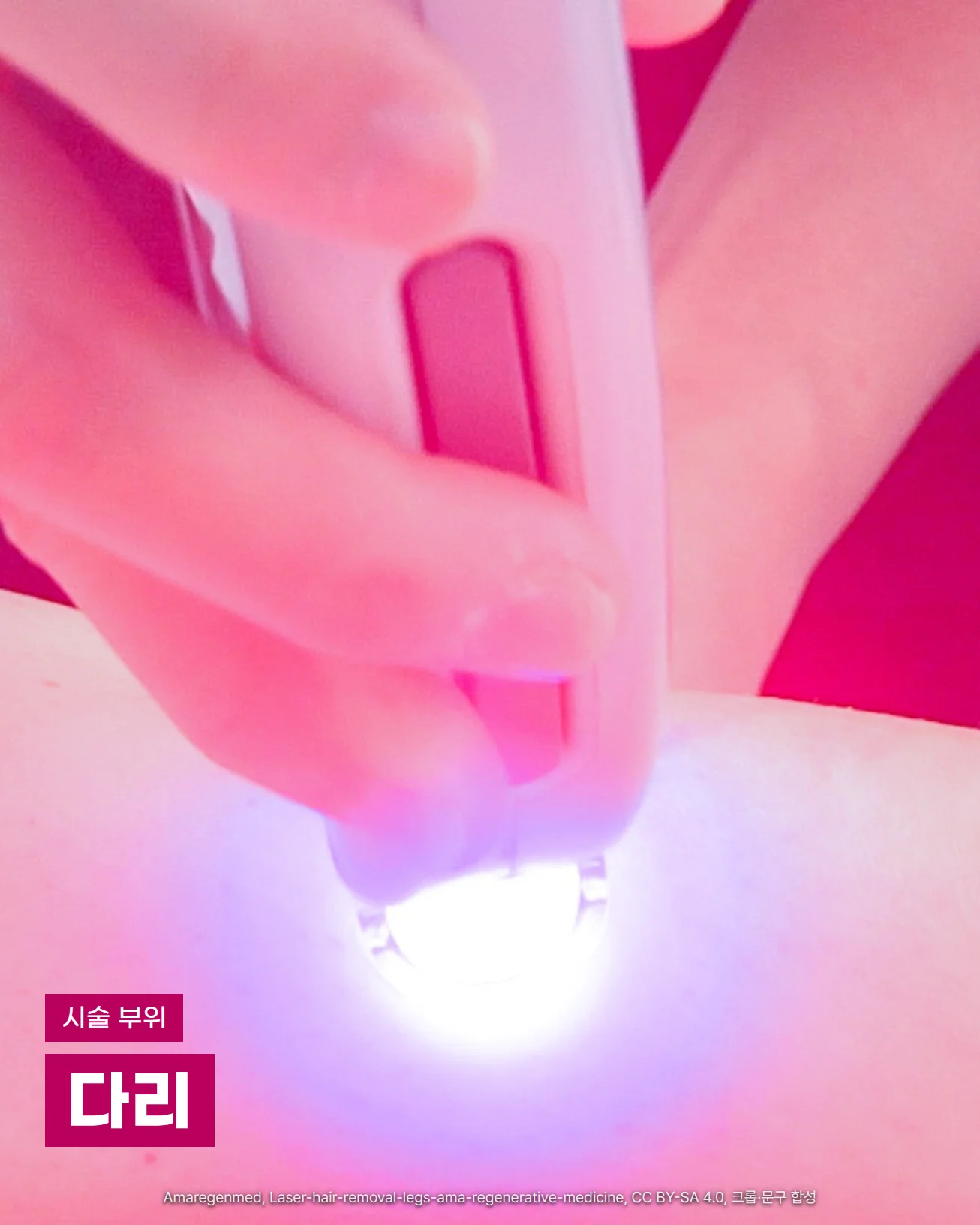 손으로 잡은 레이저 제모 핸드피스 끝을 다리 피부에 대자 흰 빛이 퍼지고, 뒤로 자홍색 옷이 보이는 근접 사진. 왼쪽 아래에 '시술 부위'와 '다리' 글자가 있습니다.