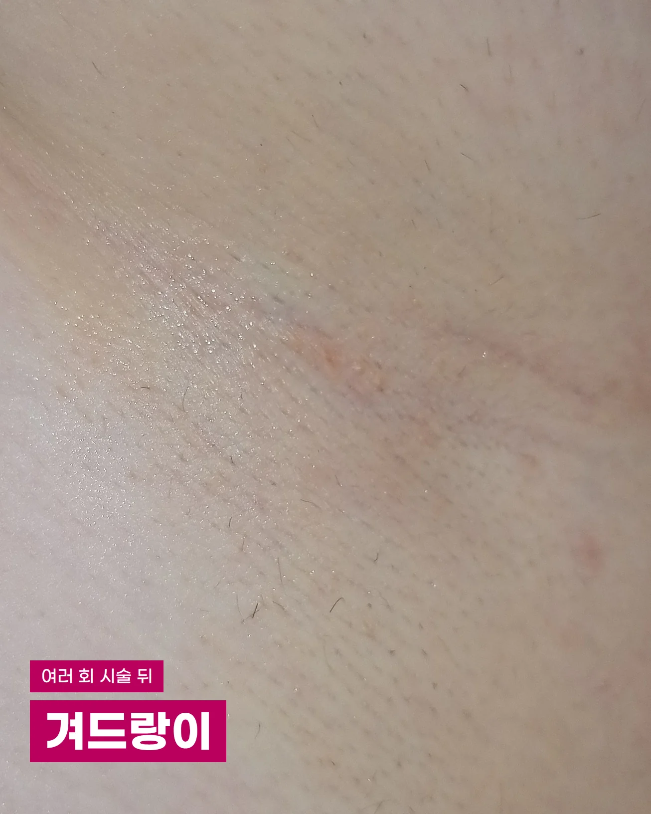 레이저 제모를 여러 회 받은 뒤 짧고 가는 털 몇 가닥만 남은 밝은 겨드랑이 피부 근접 사진. 왼쪽 아래에 '여러 회 시술 뒤'와 '겨드랑이' 글자가 있습니다.