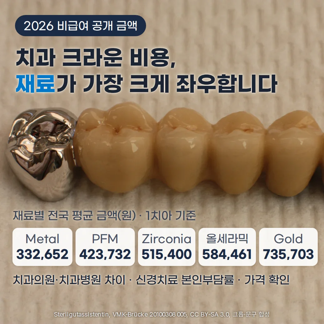 천 위에 은색 금속 크라운과 치아색 크라운이 한 줄로 이어진 치과 보철물 사진 위에 '2026 비급여 공개 금액', '치과 크라운 비용, 재료가 가장 크게 좌우합니다'라는 제목과 재료별 전국 평균 금액(1치아 기준) Metal 332,652원, PFM 423,732원, Zirconia 515,400원, 올세라믹 584,461원, Gold 735,703원, 그리고 '치과의원·치과병원 차이 · 신경치료 본인부담률 · 가격 확인'이 표시된 커버