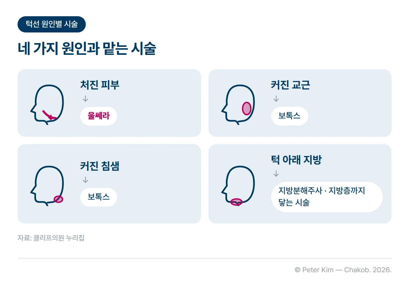 턱선이 흐려지는 원인 네 가지와 각각을 맡는 시술을 카드 네 장으로 짝지은 이미지입니다. 처진 피부는 울쎄라, 커진 교근은 보톡스, 커진 침샘은 보톡스, 턱 아래 지방은 지방분해주사 또는 지방층까지 닿는 시술이 맡습니다.