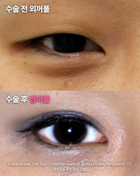 같은 사람의 한쪽 눈을 위아래로 나란히 놓은 정면 근접 사진. 위쪽은 윗눈꺼풀에 접히는 선이 없는 외꺼풀 눈이고, 아래쪽은 쌍꺼풀 수술 뒤 윗눈꺼풀에 접힌 선이 생기고 눈매에 화장을 한 눈입니다