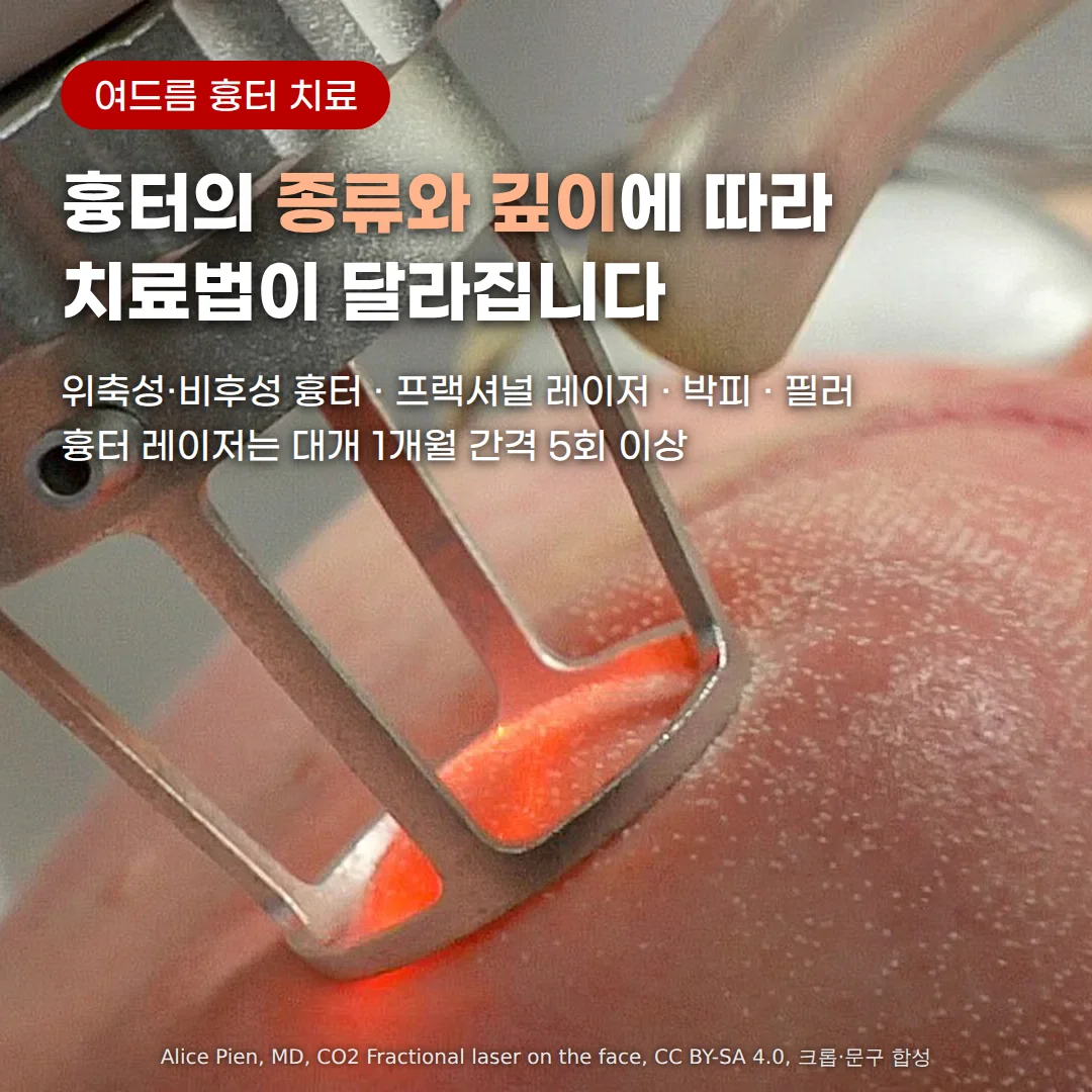 CO2 프랙셔널 레이저 핸드피스 끝이 볼 피부에 닿아 붉은 빛을 내고, 그 둘레 피부에 미세한 점이 촘촘히 찍힌 시술 장면. 위쪽에 '여드름 흉터 치료' 배지와 '흉터의 종류와 깊이에 따라 치료법이 달라집니다' 제목, '위축성·비후성 흉터 · 프랙셔널 레이저 · 박피 · 필러', '흉터 레이저는 대개 1개월 간격 5회 이상' 문구가 있습니다