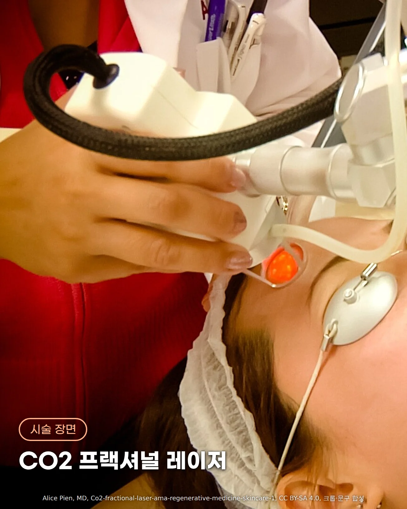 의사가 손에 든 CO2 프랙셔널 레이저 핸드피스 끝이 주황빛을 내며 은색 눈 보호대를 착용하고 누운 환자의 눈가 옆 피부에 닿아 있는 근접 사진. 아래 왼쪽에 '시술 장면' 배지와 'CO2 프랙셔널 레이저' 문구가 있습니다