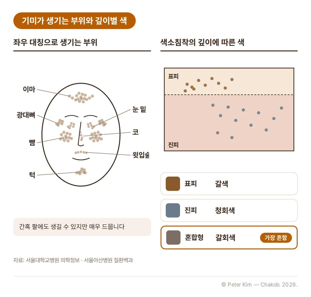 왼쪽 얼굴 정면 도식에 뺨, 광대뼈, 이마, 눈 밑, 윗입술, 코, 턱이 좌우 대칭으로 표시되어 있고 간혹 팔에도 생길 수 있지만 매우 드물다는 설명이 있습니다. 오른쪽 피부 단면 도식에는 색소침착이 표피에 있으면 갈색, 진피에 있으면 청회색, 둘이 섞인 혼합형이면 갈회색으로 나타나고 혼합형이 가장 흔하다는 내용이 있습니다