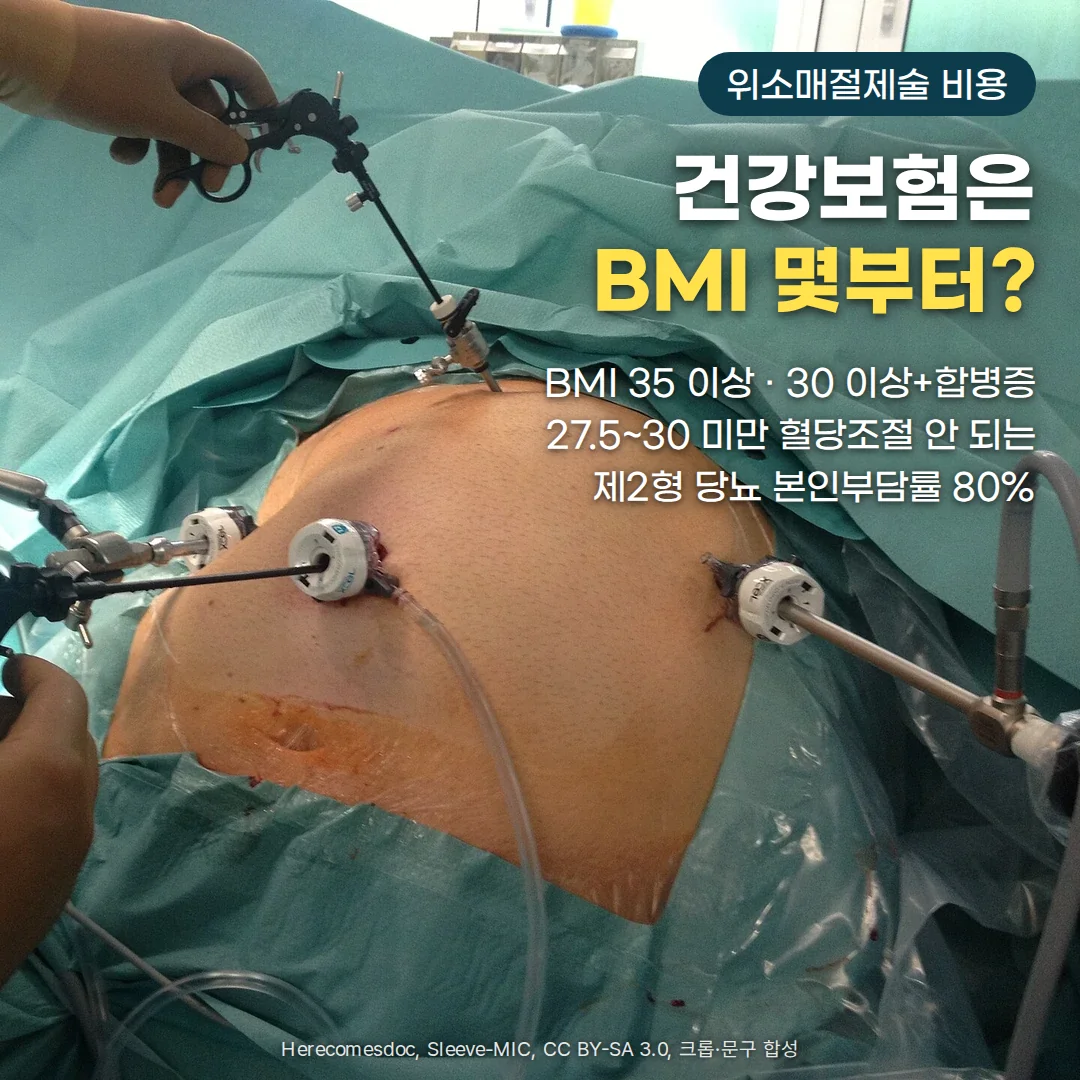 녹색 수술포를 덮은 환자의 복부에 트로카 세 개가 꽂혀 있고 장갑 낀 손이 복강경 기구를 잡고 있는 위소매절제술 수술 장면. 오른쪽 위에 '위소매절제술 비용' 배지와 '건강보험은 BMI 몇부터?' 제목, 'BMI 35 이상 · 30 이상+합병증', '27.5~30 미만 혈당조절 안 되는 제2형 당뇨 본인부담률 80%' 문구가 있습니다