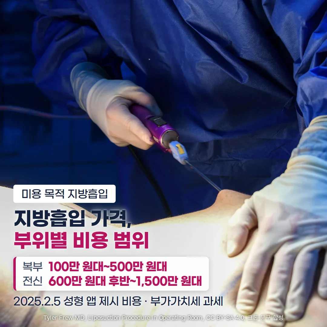 수술실에서 장갑을 낀 의료진이 보라색 손잡이의 캐뉼라를 환자의 옆구리에 넣고 다른 손으로 피부를 누르는 지방흡입수술 장면 위에, '미용 목적 지방흡입' 배지와 '지방흡입 가격, 부위별 비용 범위' 제목, 복부 100만 원대~500만 원대와 전신 600만 원대 후반~1,500만 원대를 담은 카드, '2025.2.5 성형 앱 제시 비용 · 부가가치세 과세' 문구가 있는 커버