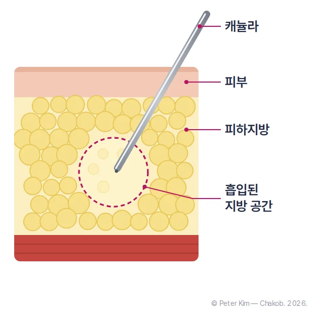 피부 단면 도해. 피부층 아래 노란 피하지방층에 비스듬히 들어간 캐뉼라 끝 둘레로 지방이 빠져나간 둥근 공간이 점선으로 표시되어 있고, 캐뉼라·피부·피하지방·흡입된 지방 공간을 가리키는 라벨이 있음
